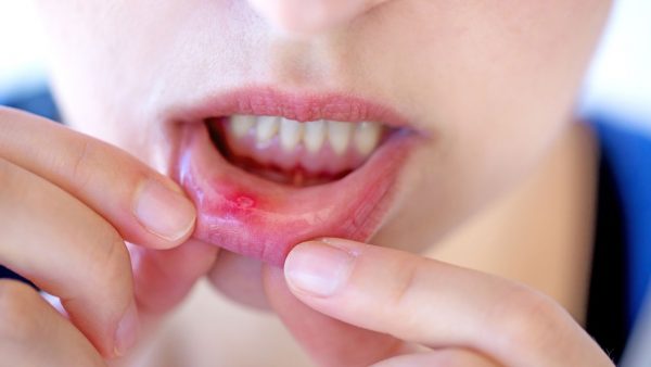 Nhiệt miệng: Nguyên nhân và cách chữa nhiệt miệng – Nha Khoa Home