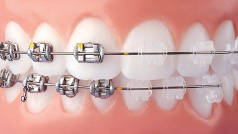 Góc giải đáp: nên niềng răng mắc cài sứ hay kim loại? 