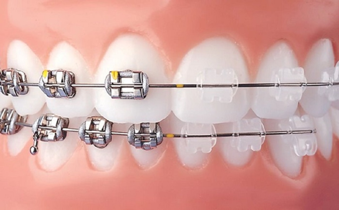 Có lợi hơn so với niềng răng mắc cài thường không?