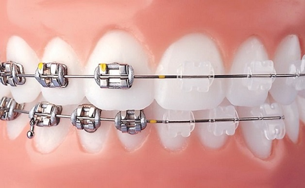 Niềng răng mắc cài kim loại hay mắc cài sứ đều có chung điểm chung là sử dụng hệ thống mắc cài kết hợp với dây cung để tạo ra lực siết chính nhằm di chuyển răng về đúng vị trí trên cung hàm.