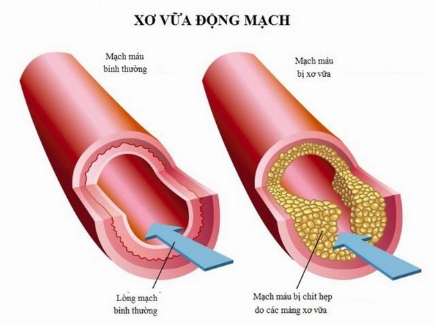 Nguyên nhân gây thiếu máu não và cách chữa trị