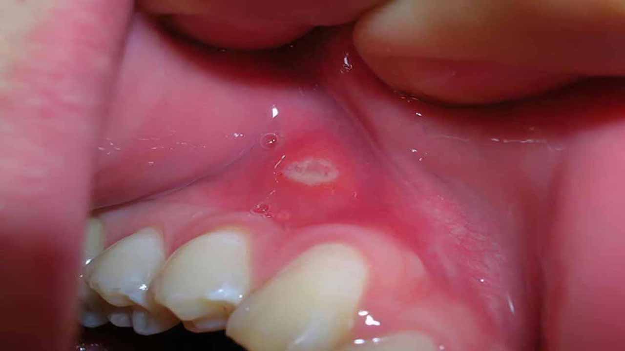 Các phương pháp chữa trị hiệu quả nhất cho nhiệt miệng ở chân răng?

