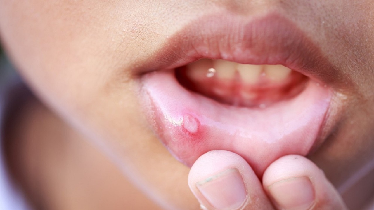 Có thể sử dụng những sản phẩm chăm sóc miệng nào cho trẻ sơ sinh bị lở miệng?