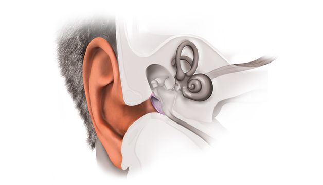 viêm ống tai trong là gì