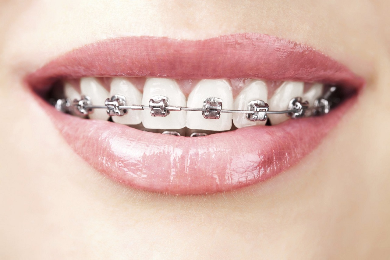Số lượng khay niềng cần dùng trong việc niềng răng lệch khớp cắn bằng Invisalign là bao nhiêu?
