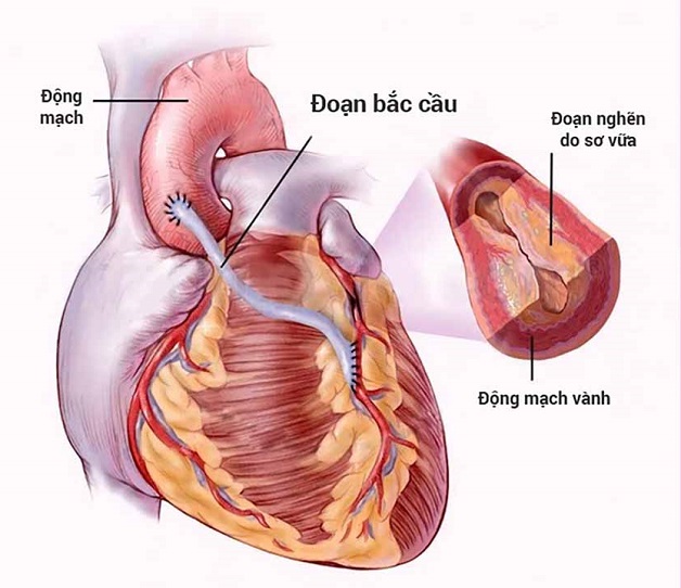 Bắc cầu động mạch vành chỉ được tiến hành trong những trường hợp cầu cơ gây hẹp động mạch vành rất nặng, điều trị bằng thuốc không đáp ứng