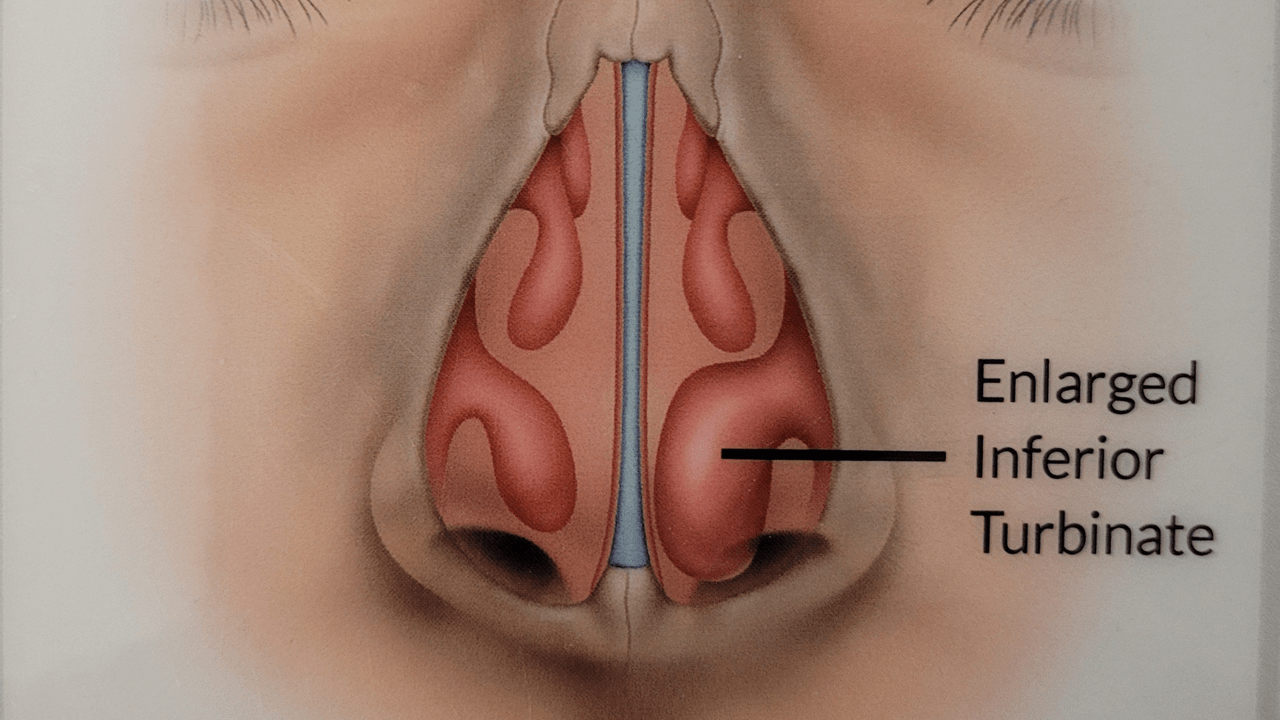 1. Tổng Quan Về Phì Đại Cuốn Mũi