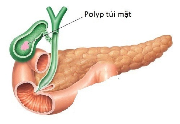 Polyp túi mật 8mm có thể dẫn đến nguy cơ ung thư túi mật