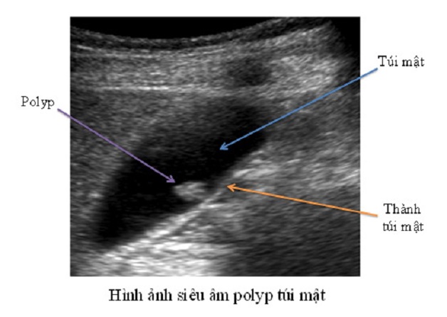 Hình ảnh polyp túi mật trên siêu âm như thế nào?| TCI Hospital