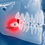 Răng khôn mọc ngầm trong xương: tác hại và cách chữa trị 