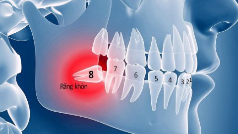 Răng khôn mọc ngầm trong xương: tác hại và cách chữa trị 
