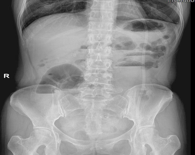 X quang ổ bụng không sửa soạn trong chẩn đoán tắc ruột 
