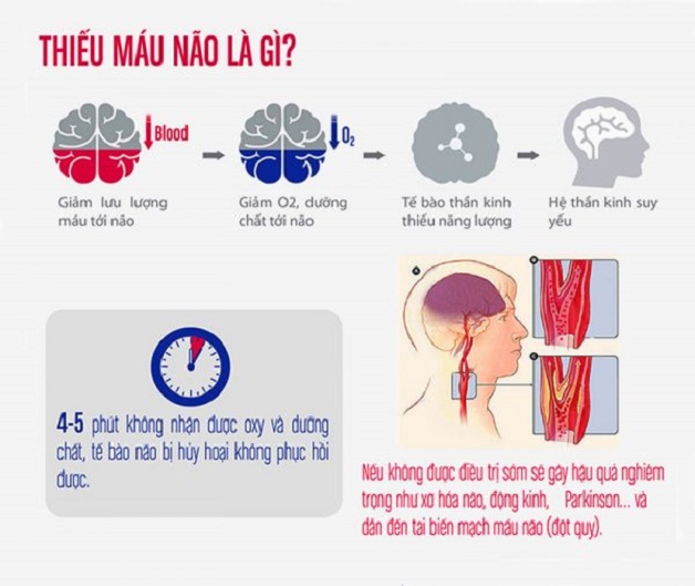 Thiếu Máu Não Cục Bộ Là Gì? Nguyên Nhân, Triệu Chứng và Cách Điều Trị