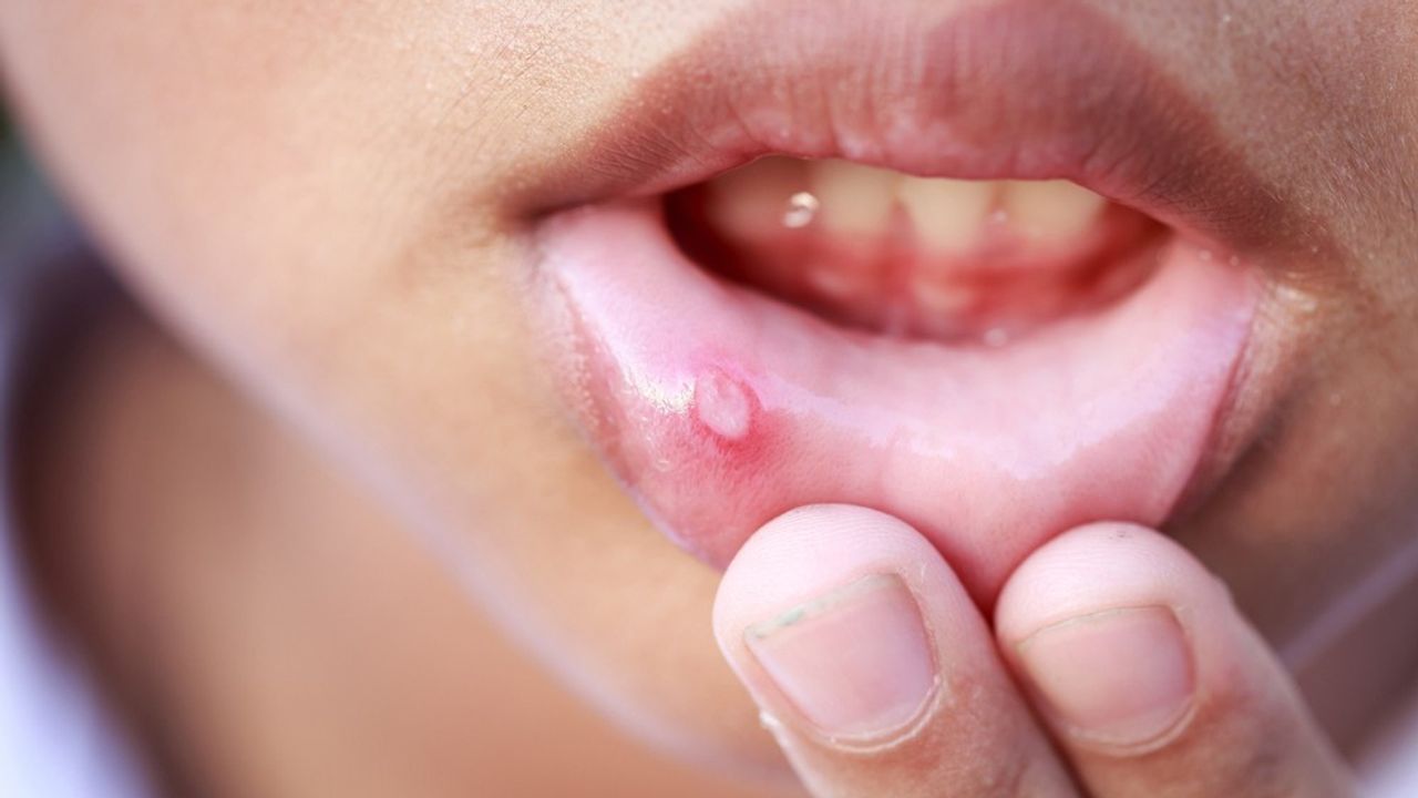 Cách sử dụng kem trị lở miệng đúng cách?
