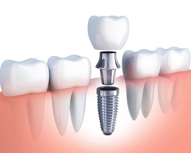 Cấy răng Implant là một phương pháp trồng răng giả cố định dùng trụ Implant thay thế cho chân răng thật