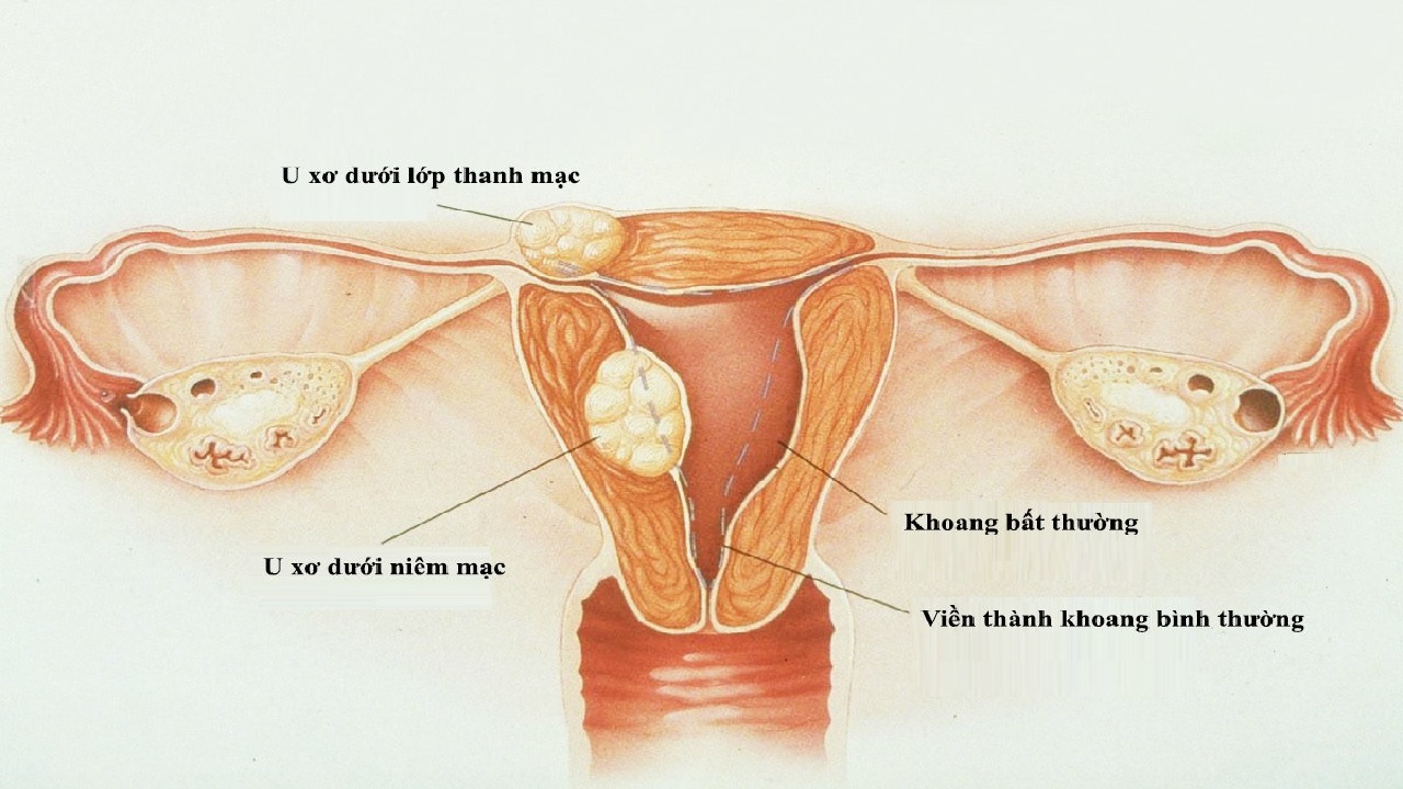 Cách điều trị u xơ tử cung dưới niêm mạc?
