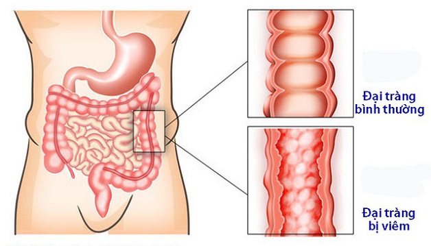 Tình trạng bệnh tái đi tái lại nhiều lần khiến nhiều người không khỏi thắc mắc viêm đại tràng mãn tính có chữa được không?