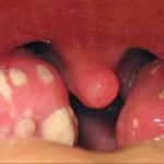 Viêm họng trắng là biểu hiện của bệnh lý nào?