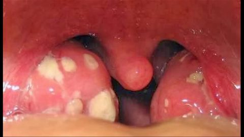 Viêm họng trắng là biểu hiện của bệnh lý nào?