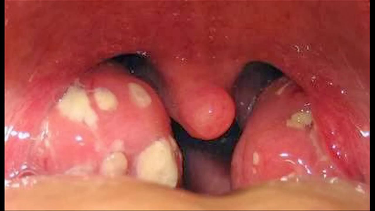 Viêm họng trắng là bệnh gì?