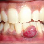 Các phương pháp điều trị viêm nướu răng có mủ