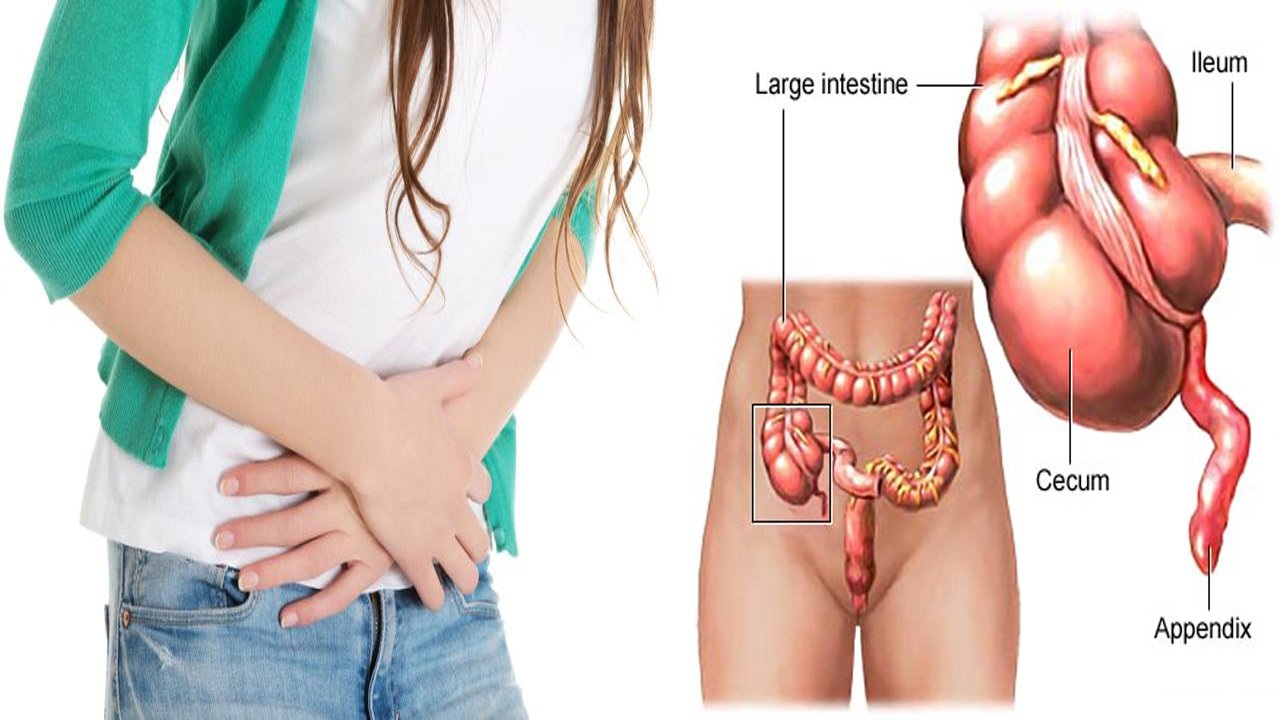 Đâu là những triệu chứng của viêm ruột thừa tiểu khung?
