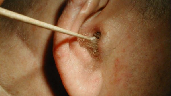 Giải đáp thắc mắc: Viêm tai ngoài có tự khỏi không? | TCI Hospital