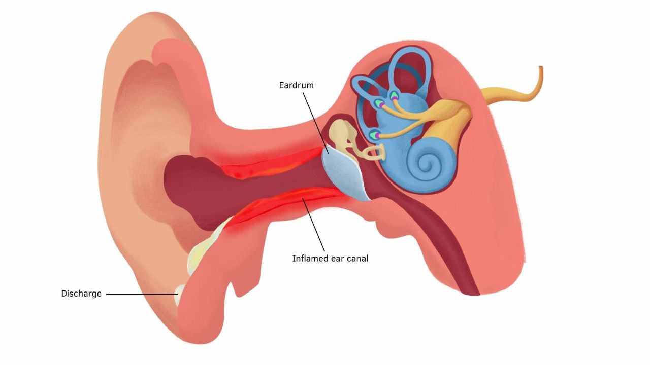 Viêm tai giữa có liên quan đến chế độ ăn uống không?
