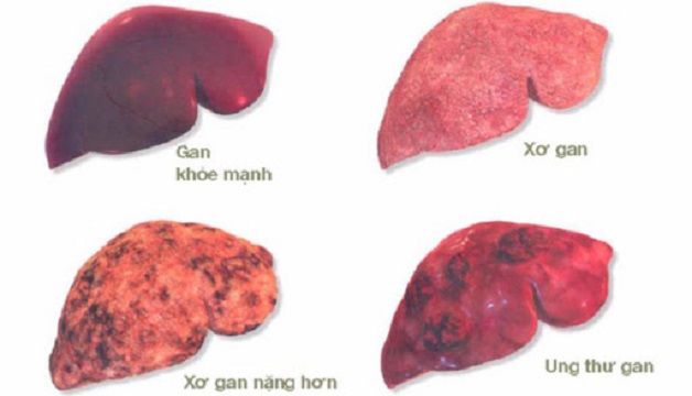 Nếu không chữa trị sớm rất có thể bệnh sẽ dẫn tới ung thư gan