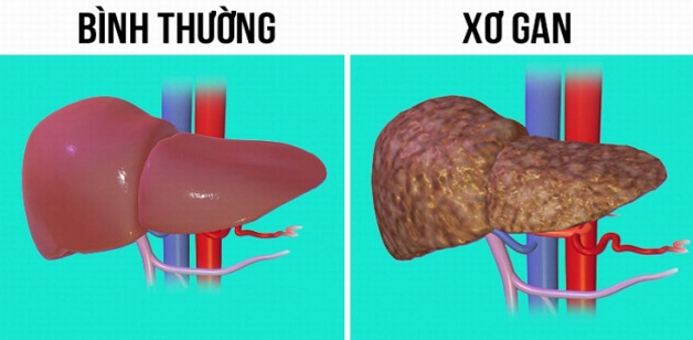 Xơ Hóa Gan: Khái Niệm, Nguyên Nhân Và Phương Pháp Điều Trị