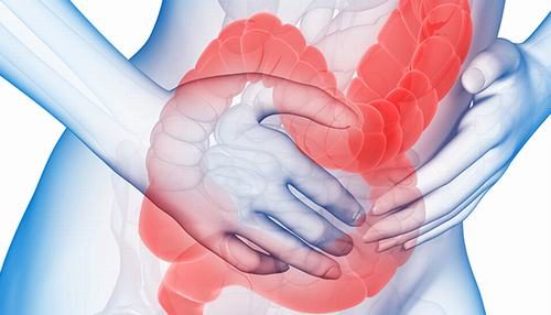 Nếu từng mắc bệnh Crohn hoặc viêm loét đại tràng sẽ có nhiều nguy cơ bị viêm đại tràng.