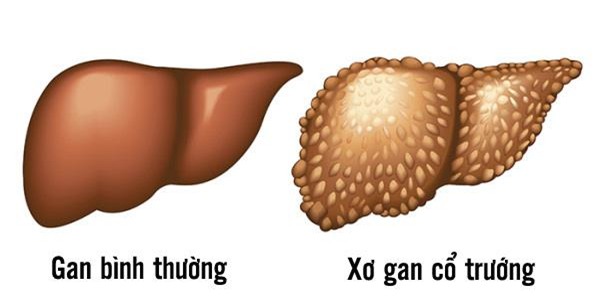 Xơ gan cổ trướng giai đoạn đầu | TCI Hospital