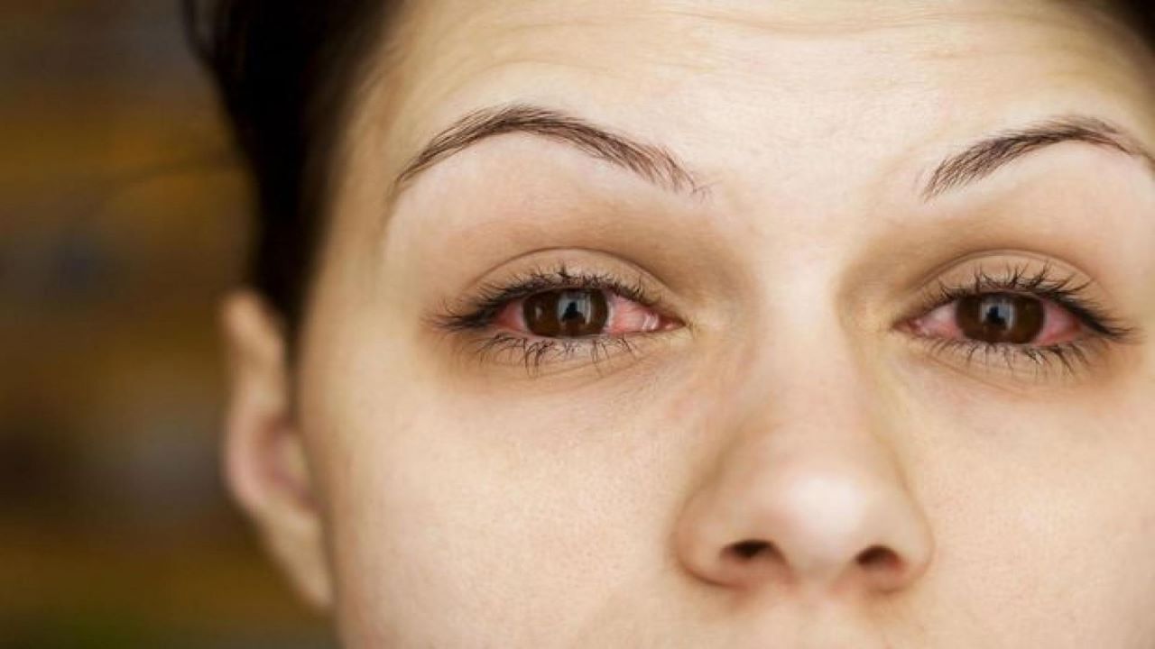 Có cách nào chữa trị đau mắt đỏ cho bà bầu không?
