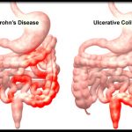 Bệnh Crohn đại tràng