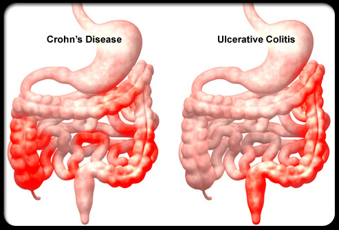 Bệnh Crohn là một bệnh viêm ruột xuyên thành mạn tính, điều này có nghĩa là gì?
