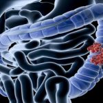 Bệnh Crohn là gì và những dấu hiệu nhận biết bệnh Crohn
