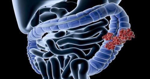 Phương pháp chẩn đoán bệnh Crohn là gì? 
