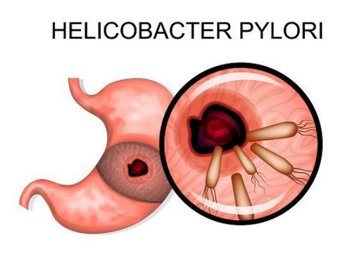 Vi khuẩn Helicobacter pylori là một trong những 