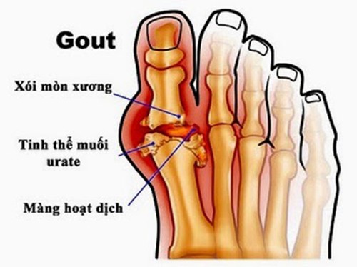 7. Các câu hỏi thường gặp về bệnh gout