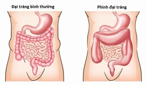 Bệnh phình đại tràng là bệnh bẩm sinh thường gặp ở trẻ.
