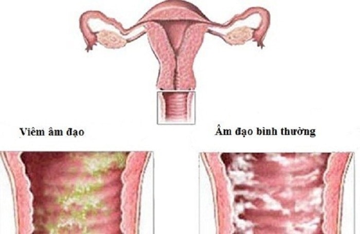 Viêm âm đạo là bệnh phụ khoa thường gặp ở nữ giới