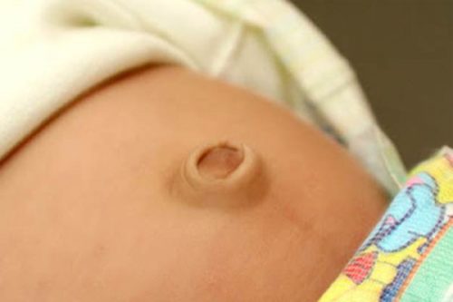 Thoát vị rốn là bệnh rất phổ biến ở trẻ sơ sinh đặc biệt là trẻ nhẹ cân và sinh non