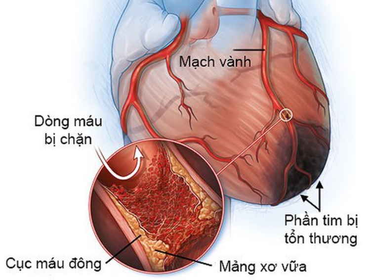 Bệnh tim mạch vành là gì?