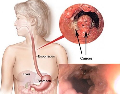 Ung thư thực quản chia thành 4 giai đoạn.