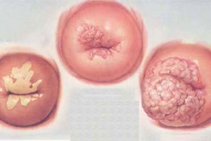 Viêm quanh lỗ cổ tử cung là một trong những bệnh lý rất nhiều chị em mắc phải