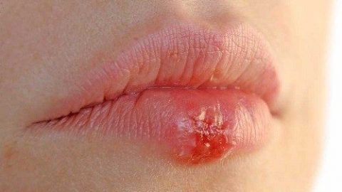 Bị herpes ở môi khi mang thai