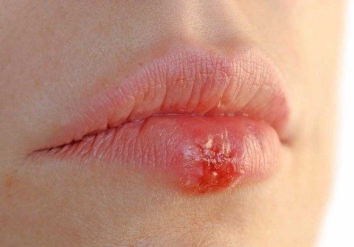 What are the common causes of water blisters on the lips during pregnancy?