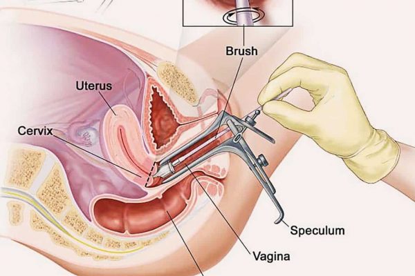 Polyp cổ tử cung thường xuất hiện triệu chứng đau âm ỉ kéo dài
