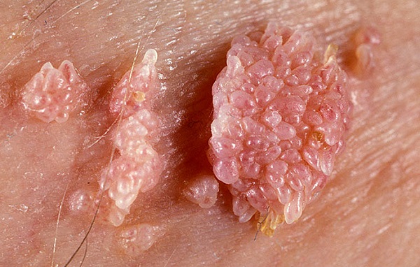 Sùi mào gà là tên gọi một loại bệnh lây truyền qua đường tình dục, do virut HPV gây nên