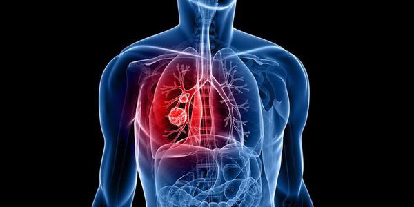 Ung thư phổi là bệnh nguy hiểm nên cần điều trị sớm, đúng phương pháp
